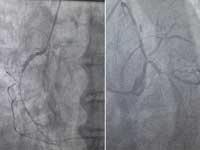 120 kg diabetic hypertensive OSA patient came with MI in shock.Severe triple vessel CAD and EF 25%, was turned down for CABG. We Yashoda Medicity did Ghaziabad/West UPs first IMPELLA assisted high risk PTCA and pt discharged walking 4 days after ptca (planned for 2nd stage ptca).