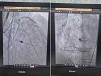 120 kg diabetic hypertensive OSA patient came with MI in shock.Severe triple vessel CAD and EF 25%, was turned down for CABG. We Yashoda Medicity did Ghaziabad/West UPs first IMPELLA assisted high risk PTCA and pt discharged walking 4 days after ptca (planned for 2nd stage ptca).